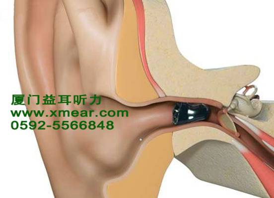 IIC助听器 厦门助听器